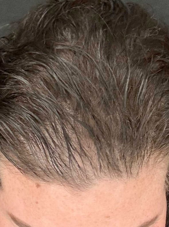 Top 10 anti haaruitval bij mannen